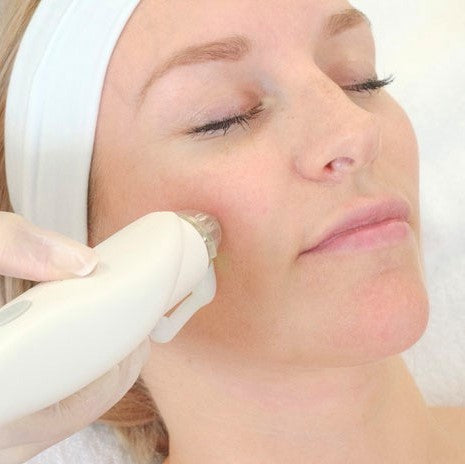 Radiofrequency Microneedling – Signature Beauty Lounge